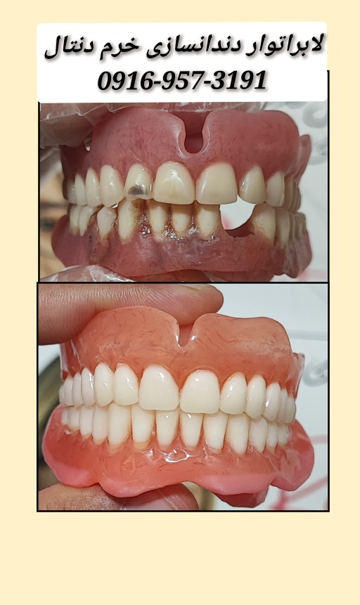 پروتز متحرک