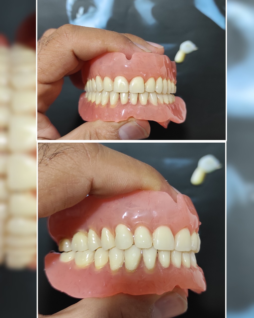 ترمیم لثه آسیب دیده