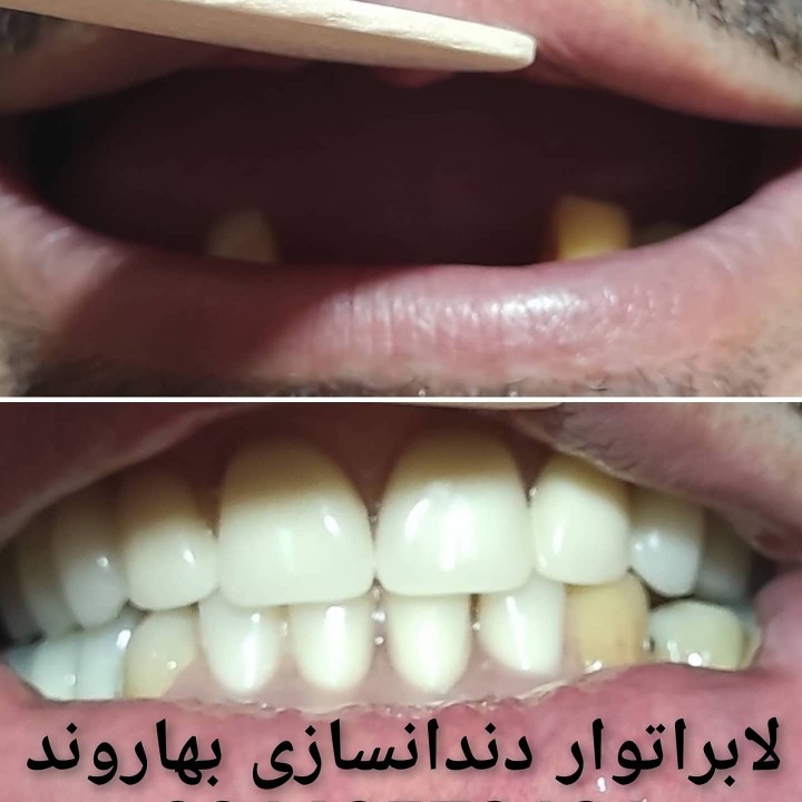 ساخت دندان مصنوعی پارسیل